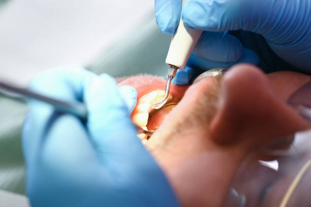 Best Emergency Dental Extractions in Prince George, VA