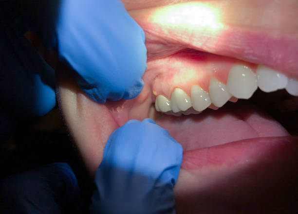 Best Emergency Dental Care for Abscessed Tooth in Prince George, VA